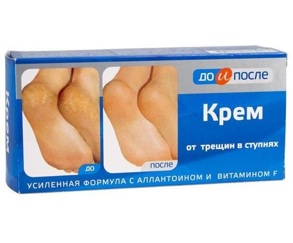 до и после крем от трещин в ступнях 50 мл