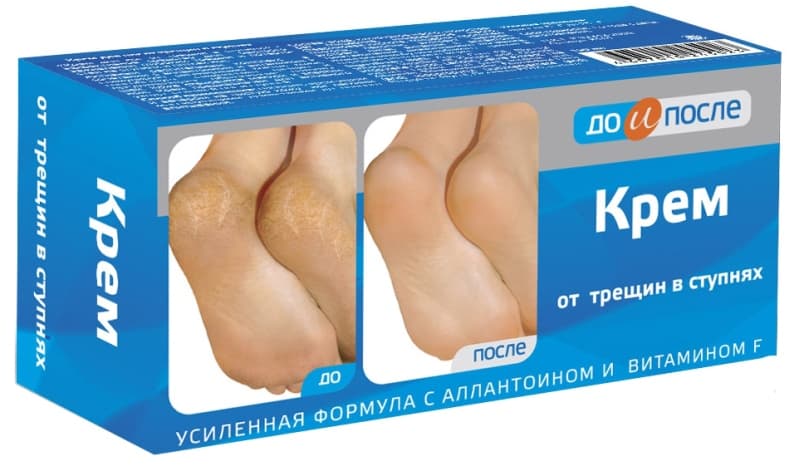 до и после крем от трещин в ступнях 150мл